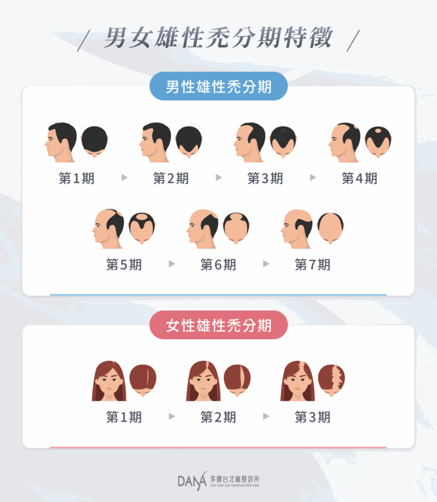 男女雄性禿分期特徵