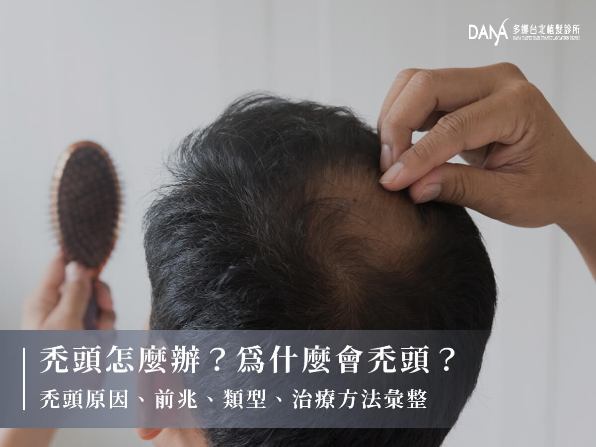 禿頭怎麼辦？為什麼會禿頭？禿頭原因、前兆、類型、治療方法彙整