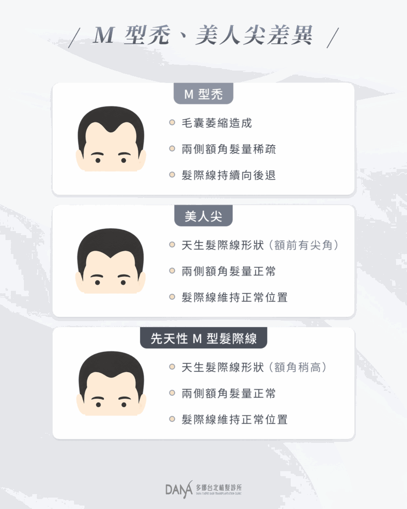 M 型禿、美人尖差異