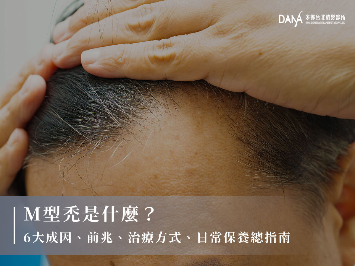 M型禿是什麼？6大成因、前兆、治療方式、日常保養總指南