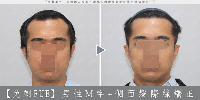 嚴重 M 型禿植髮案例