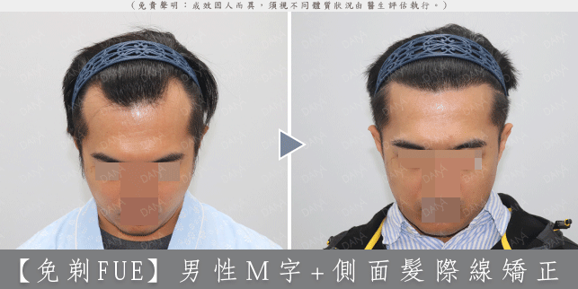 嚴重 M 型禿植髮案例