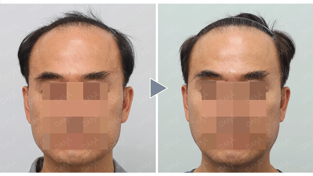 二次植髮免剃FUE植髮術後成果照