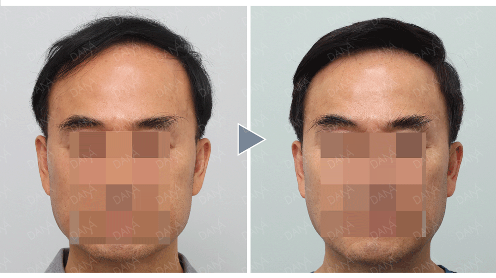 二次植髮免剃FUE植髮術後成果照