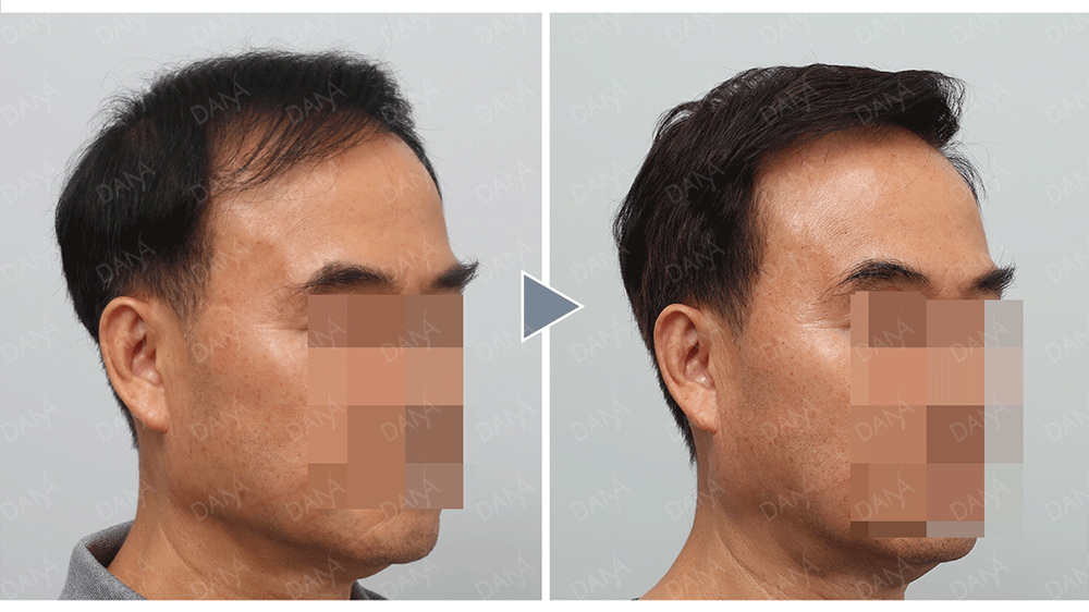 免剃FUE植髮 二次植髮免剃FUE植髮術後成果照