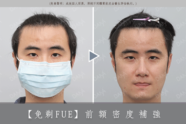 扁塌瀏海植髮完<br>也能蓬鬆有厚度<br>|免剃FUE植髮|(Non-shaven FUE)