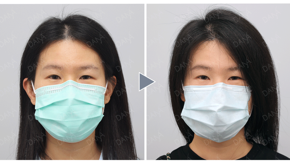 女性頭頂分線植髮前後對比：頭頂髮際分線由寬變窄，髮量視覺蓬鬆度提升