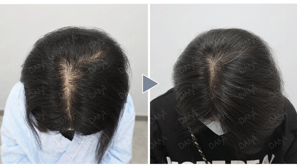 女性頭頂分線植髮前後對比：頭頂髮際分線由寬變窄，髮量視覺蓬鬆度提升