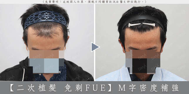 FUE 案例1-1