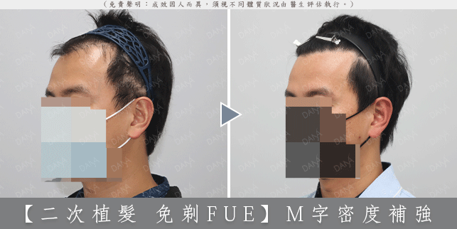 FUE 案例 1-2