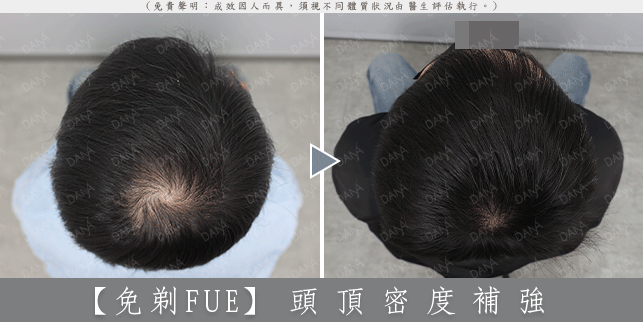 FUE 案例 02-1