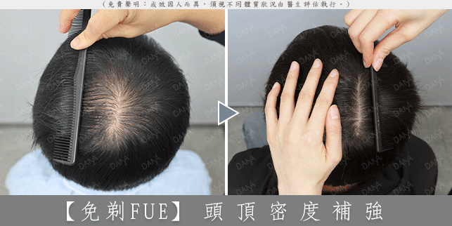 FUE 案例 02-2
