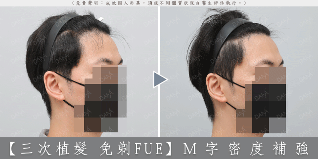 FUE 案例 03-2