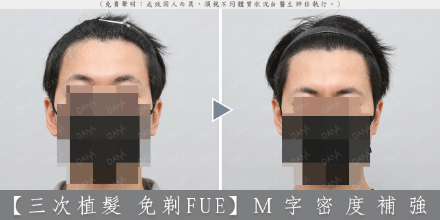 FUE 案例 2-1