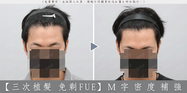 FUE 案例 2-2
