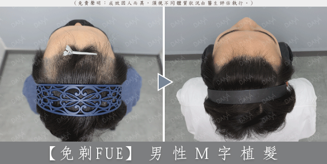 FUE 案例 3-1