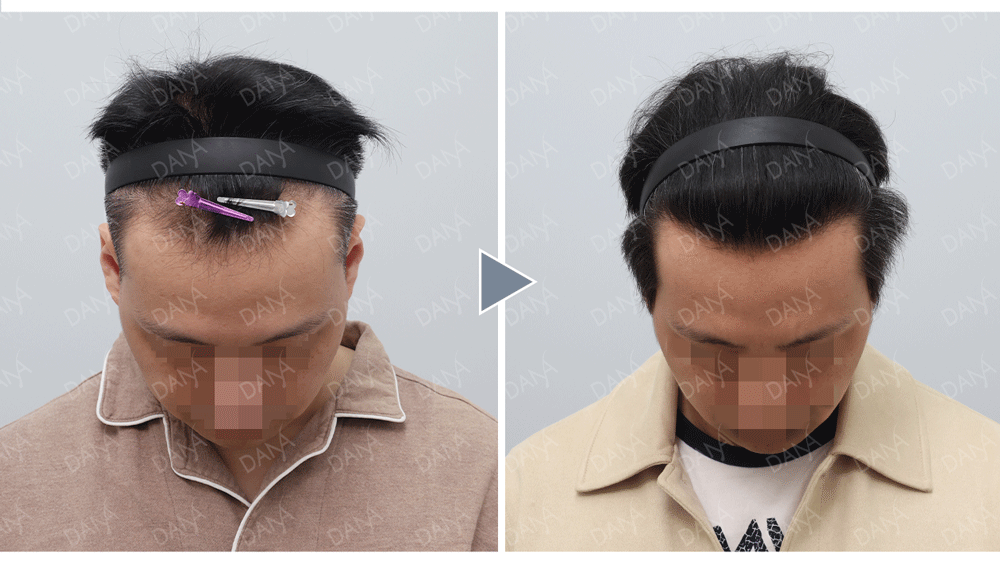 40歲植髮心得,手術前後對比圖