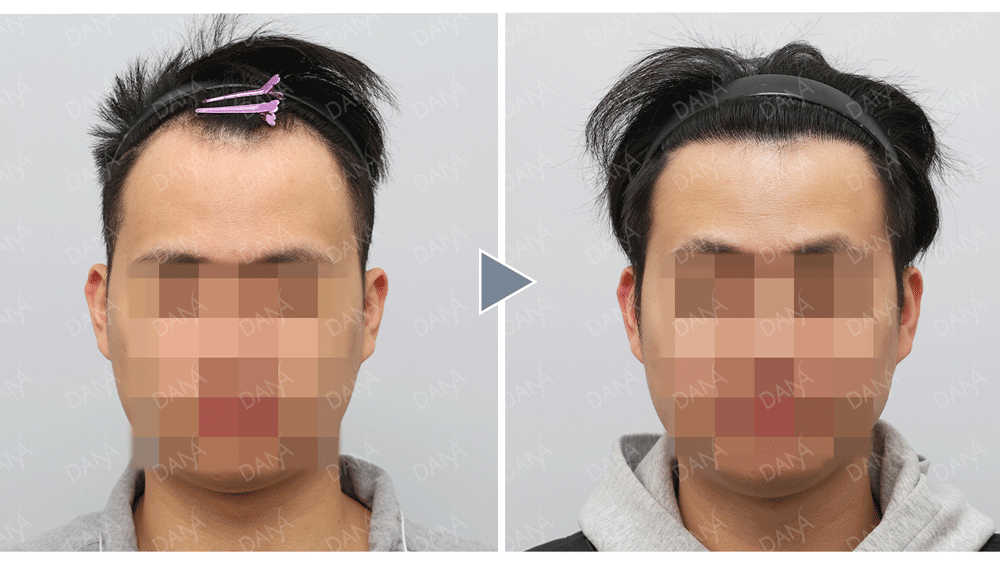 30初髮友北上植髮心得分享|M型+前額密度補強|