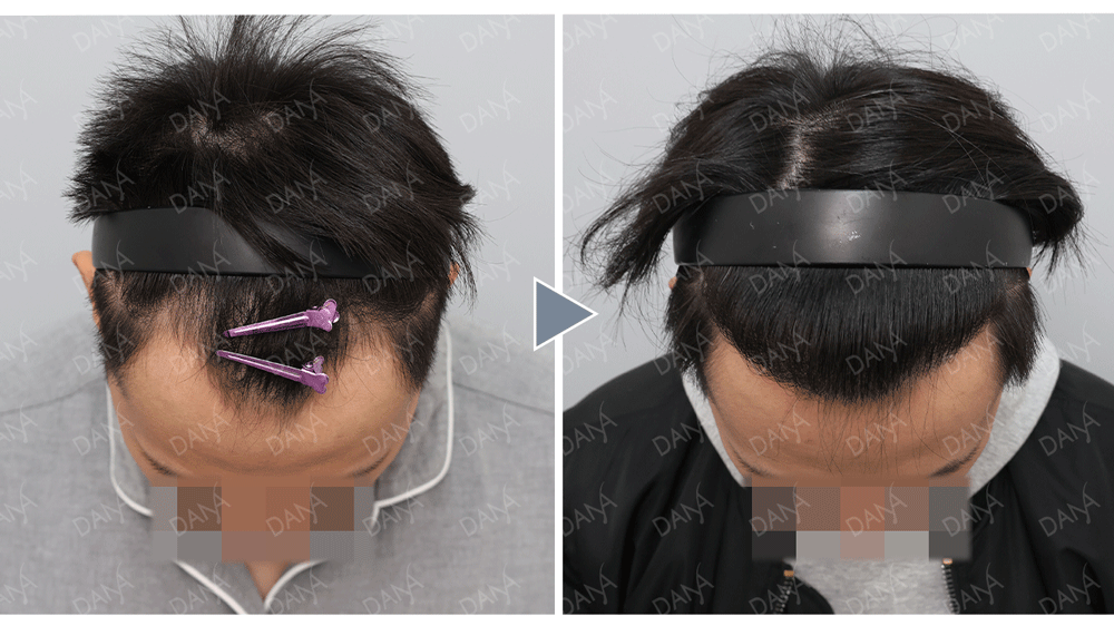 30初髮友北上植髮心得分享|M型+前額密度補強