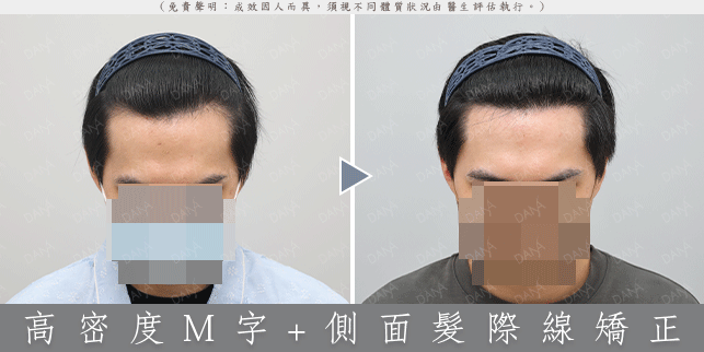 輕微 M 型禿植髮案例