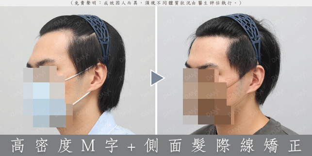 輕微 M 型禿植髮案例