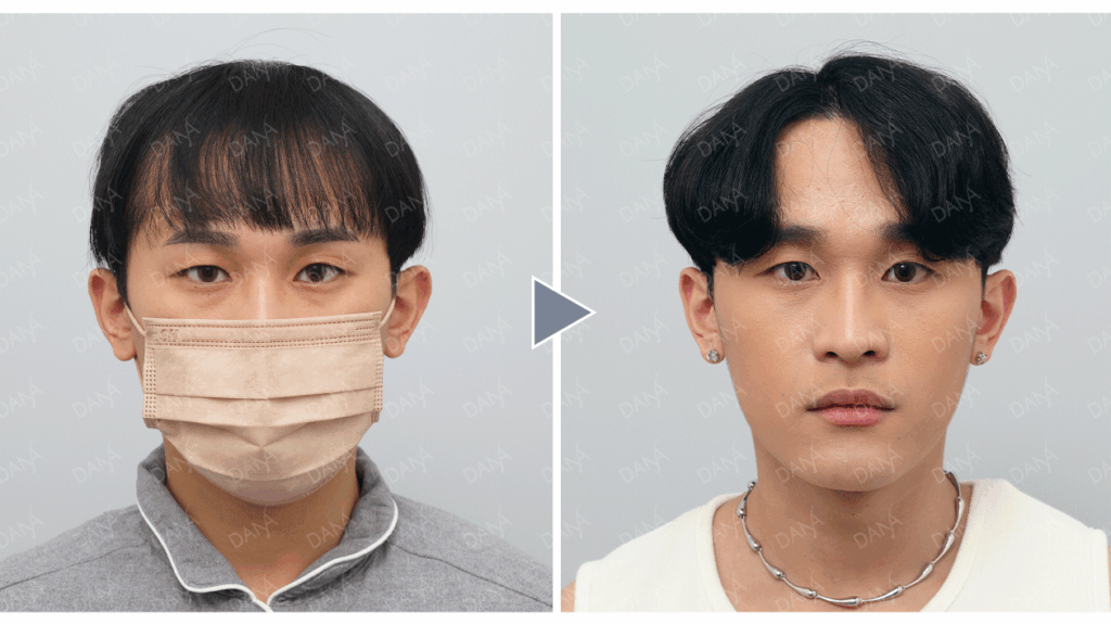 中度 M 型禿植髮案例