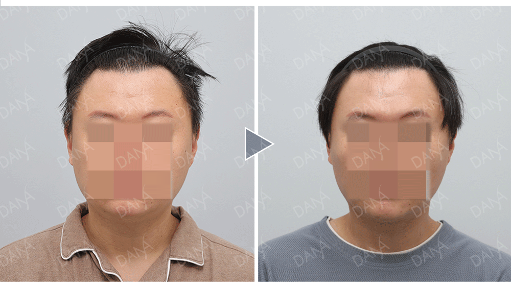 高密度M型植髮與前額密度補強植髮手術案例，窟髮正面展示手術前後髮際線差異