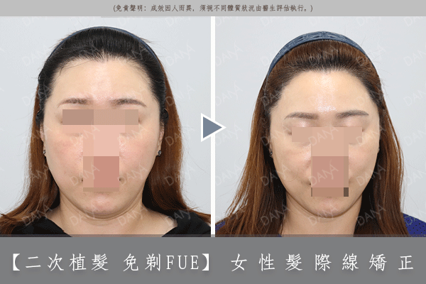 美型臉蛋不再是夢想<br>女性髮際線矯正<br>|免剃FUE植髮|<br>(Non-shaven FUE)